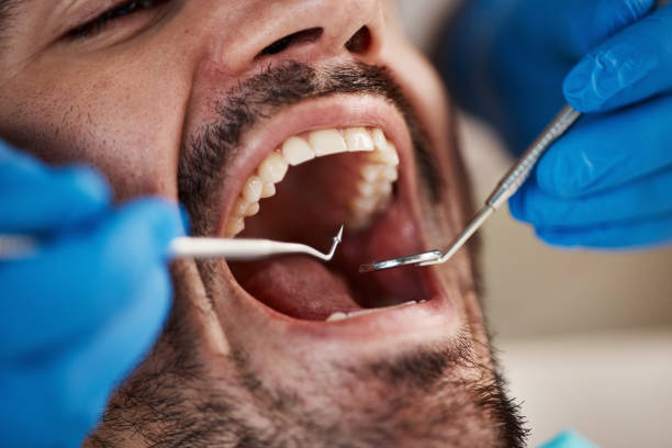 Best Dental Abscess Treatment in Meriden, CT